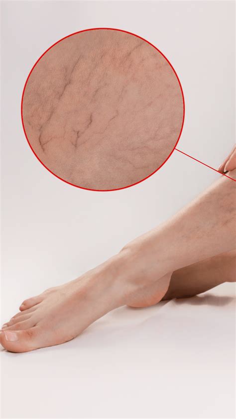 leziuni ale pielii pe picioare cu varice